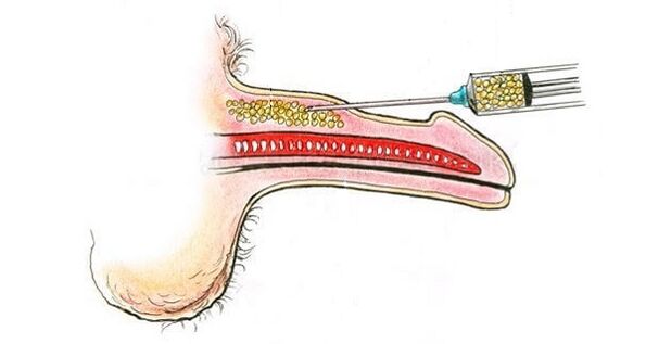 Iniezioni di acido ialuronico nella canna di un membro per aumentarlo